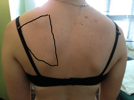 6 Overlooked Remedies for Lower Back Pain Relief- Part 2