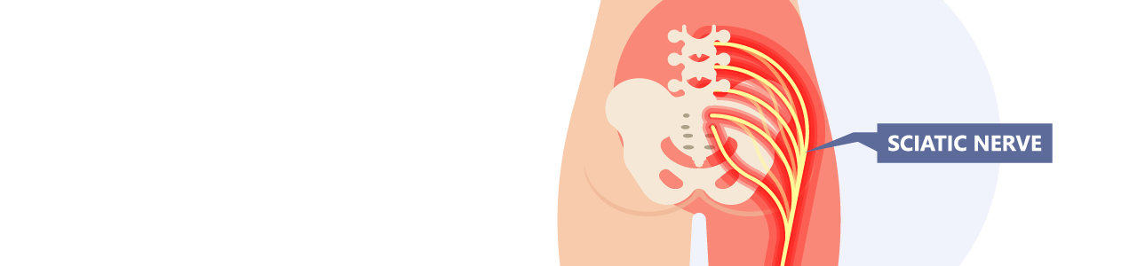 Sciatica Relief